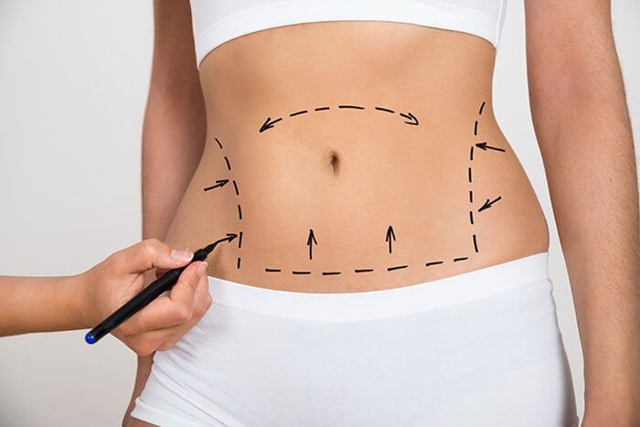 Before You Book Liposuction: 10 Things to Consider